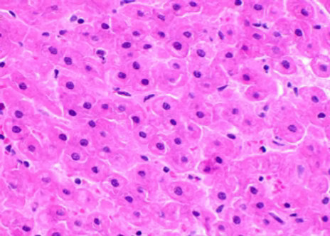 MorCor pathology Hor